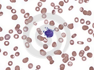 Acute megakaryoblastic leukemia in peripheral blood.