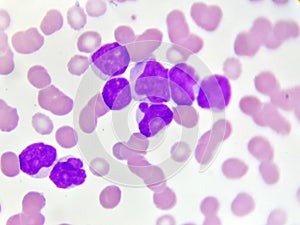 Acute myeloid leukemia