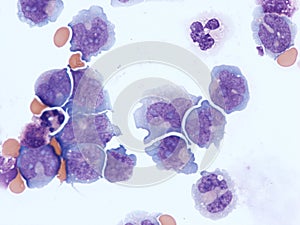 Acute myeloid leukemia with central nervous system involvement