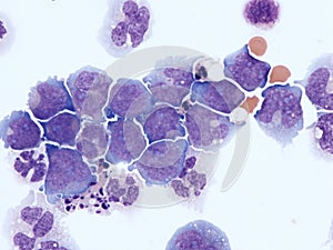 Acute myeloid leukemia in cerebrospinal fluid