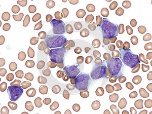 Acute myeloid leukemia. peripheral blood.