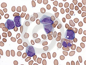 Acute myeloid leukemia. peripheral blood.