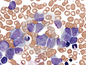 Acute myelomonocytic leukemia with hyperleukocytosis.