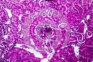 Acute nephritis, light micrograph