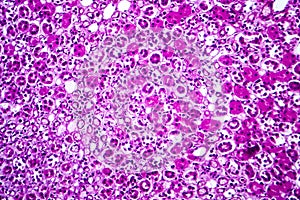 Acute nephritis, light micrograph