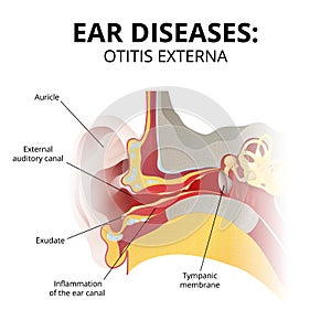 acute otitis externa, sectional image on white background photo