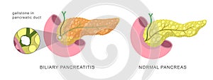 Acute pancreas inflamation caused by the obstruction of the pancreatic duct with stones. Biliary pancreatitis. Disease