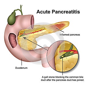 Acute pancreatitis 3d medical  illustration on white background