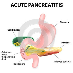 Acute pancreatitis