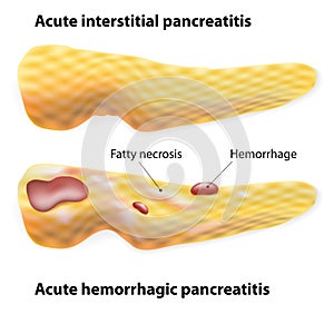 Acute Pancreatitis