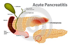 Acute Pancreatitis caused. Gallstones block the flow of pancreatic juices into the duodenum.
