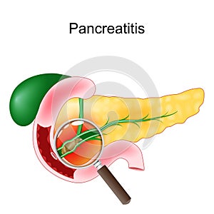 Acute pancreatitis. Close-up of a realistic pancreas, duodenum, and gallbladder