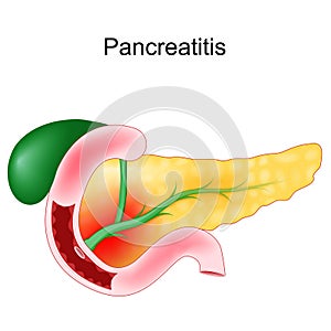 Acute pancreatitis. Duodenum, gallbladder and pancreas photo