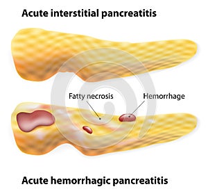 Acute Pancreatitis photo