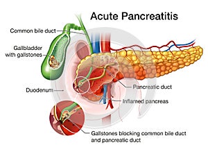 Acute pancreatitis, medically illustration