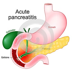 Acute pancreatitis. Pancreas inflammation photo