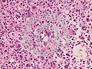 Acute panmyelosis with myelofibrosis.