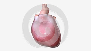 Acute pericarditis is often caused by a bacterial or viral infection.