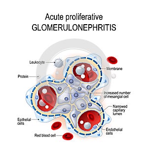 Acute proliferative glomerulonephritis photo