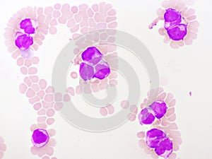Acute promyelocytic leukemia cells or APL