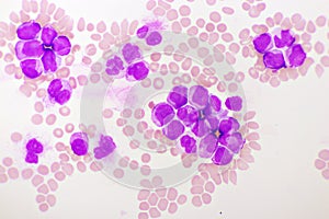 Acute promyelocytic leukemia cells or APL photo