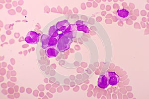 Acute promyelocytic leukemia cells or APL photo