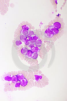 Acute promyelocytic leukemia cells or APL photo