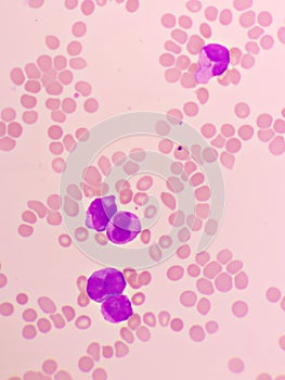Acute promyelocytic leukemia cells or APL photo