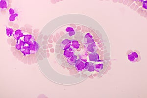 Acute promyelocytic leukemia cells or APL photo