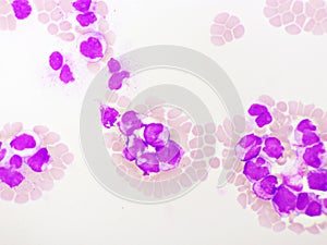 Acute promyelocytic leukemia cells or APL photo