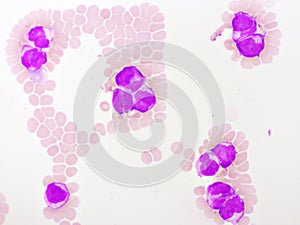 Acute promyelocytic leukemia cells or APL photo