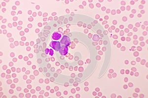Acute promyelocytic leukemia cells or APL photo