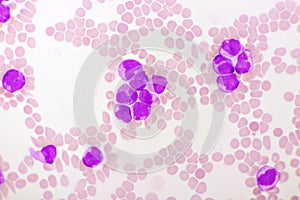 Acute promyelocytic leukemia cells or APL photo