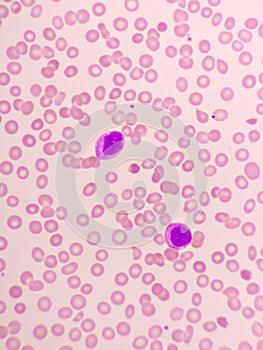 Acute promyelocytic leukemia cells or APL photo