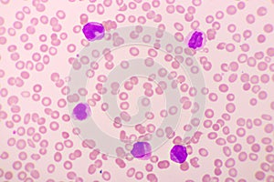 Acute promyelocytic leukemia cells or APL photo