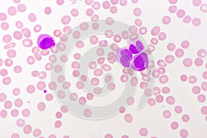 Acute promyelocytic leukemia cells or APL photo