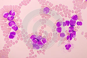Acute promyelocytic leukemia cells or APL photo