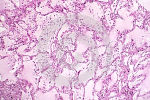 Acute pulmonary edema