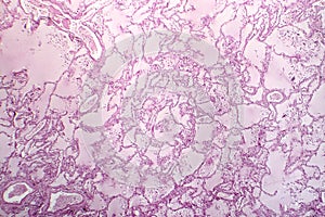 Acute pulmonary edema