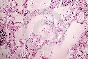 Acute pulmonary edema