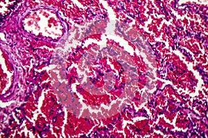 Acute pulmonary hemorrhage