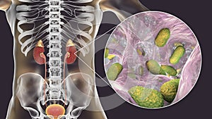 Acute pyelonephritis caused by bacteria Acinetobacter baumannii, medical concept