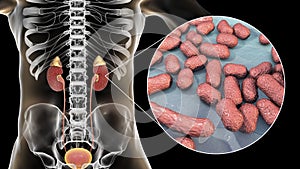 Acute pyelonephritis caused by bacteria Acinetobacter baumannii, medical concept