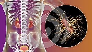 Acute pyelonephritis caused by bacteria Escherichia coli, medical concept photo