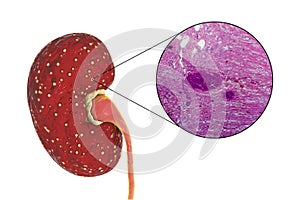 Acute pyelonephritis, gross morphology and histopathology photo