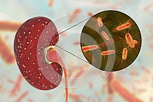 Acute pyelonephritis, medical concept, and close-up view of bacteria Escherichia coli