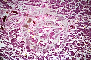 Acute severe hepatitis, light micrograph photo