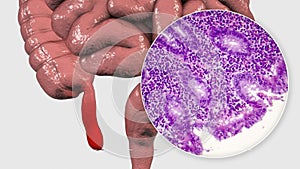 Acute suppurative appendicitis, illustration and light micrograph