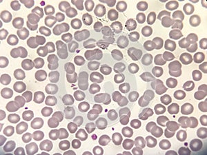 Acute thrombocytopenia and leucocytopenia. photo
