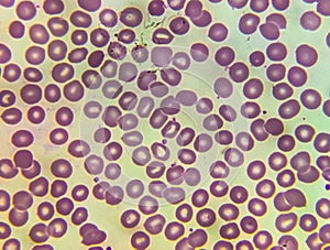 Acute thrombocytopenia and leucocytopenia. photo